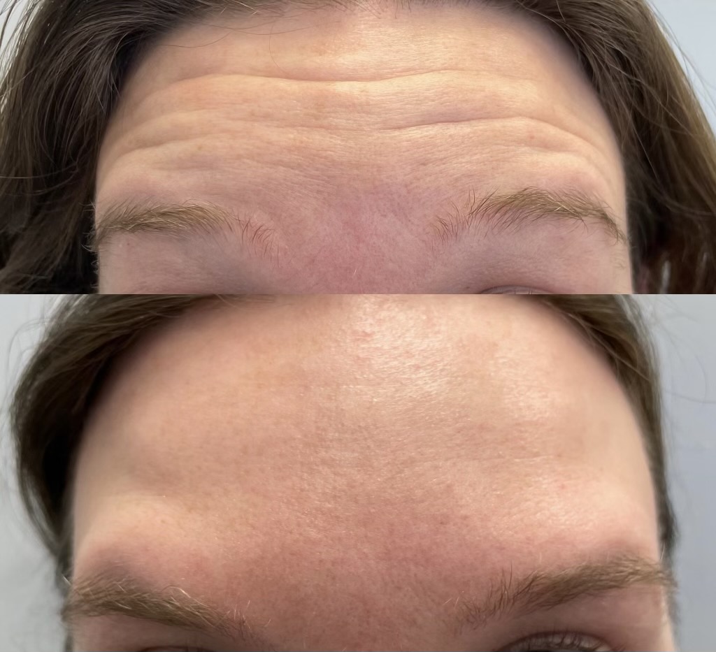 Emily Lucille Botox Before and After Fairfield Dermatology